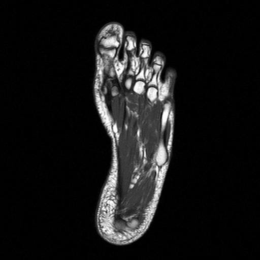 снимок МРТ суставов стопы